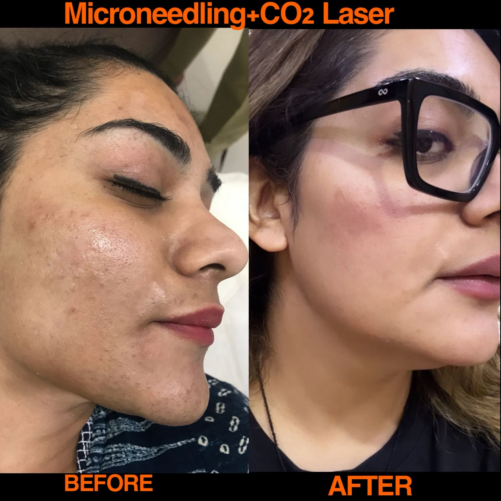 Carbon Laser Facial Results