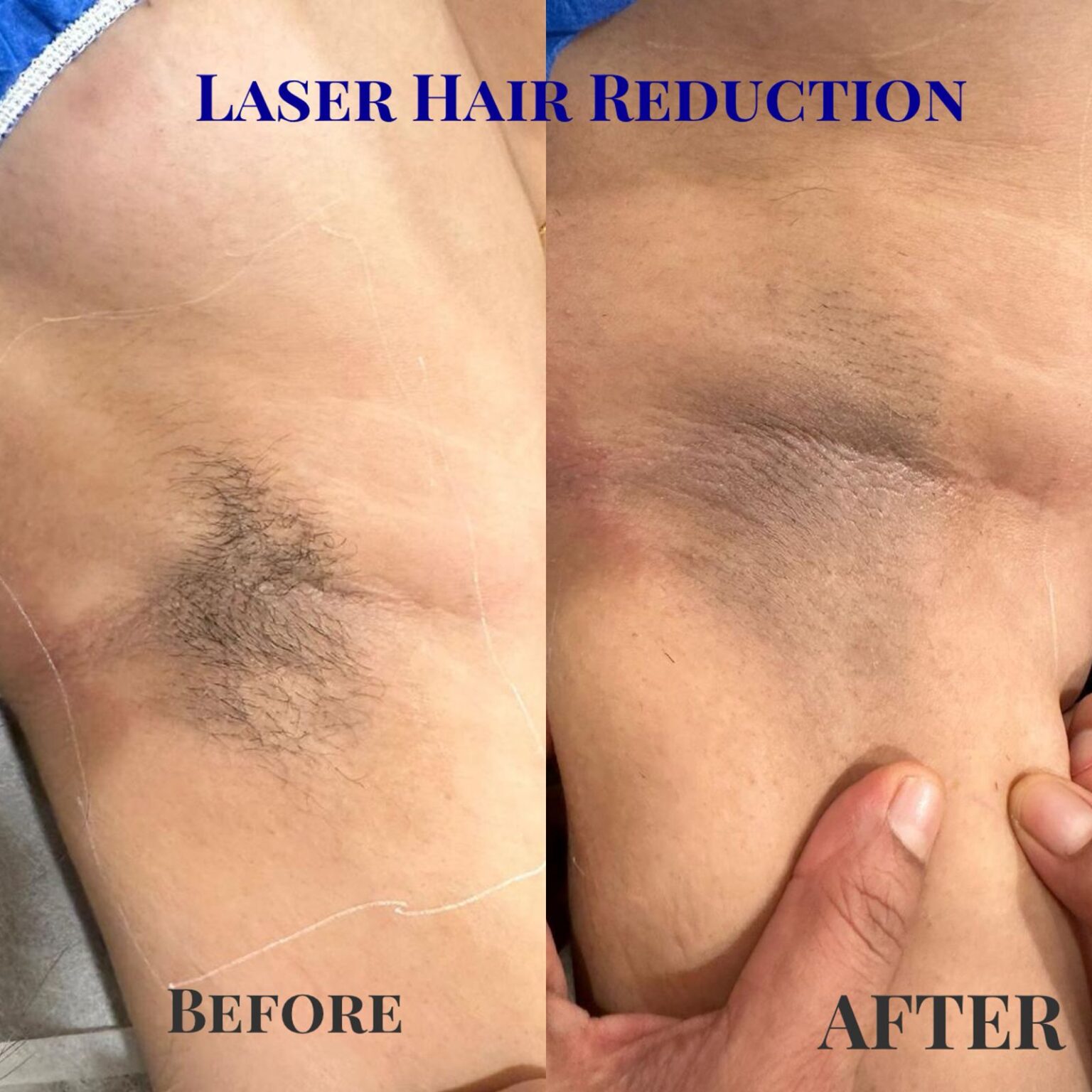 Laser Hair Reduction