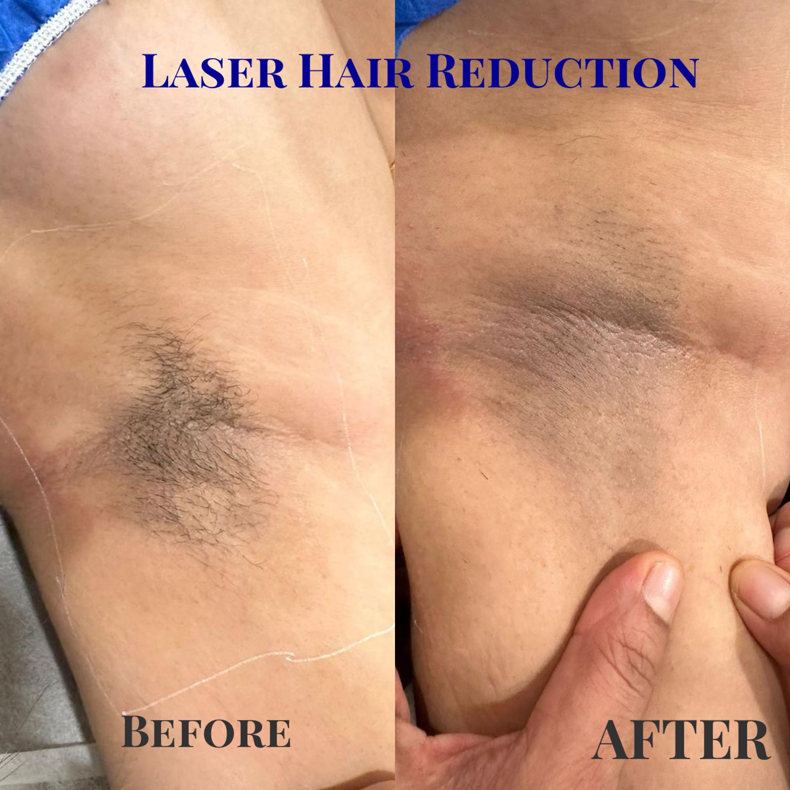Laser Hair Reduction