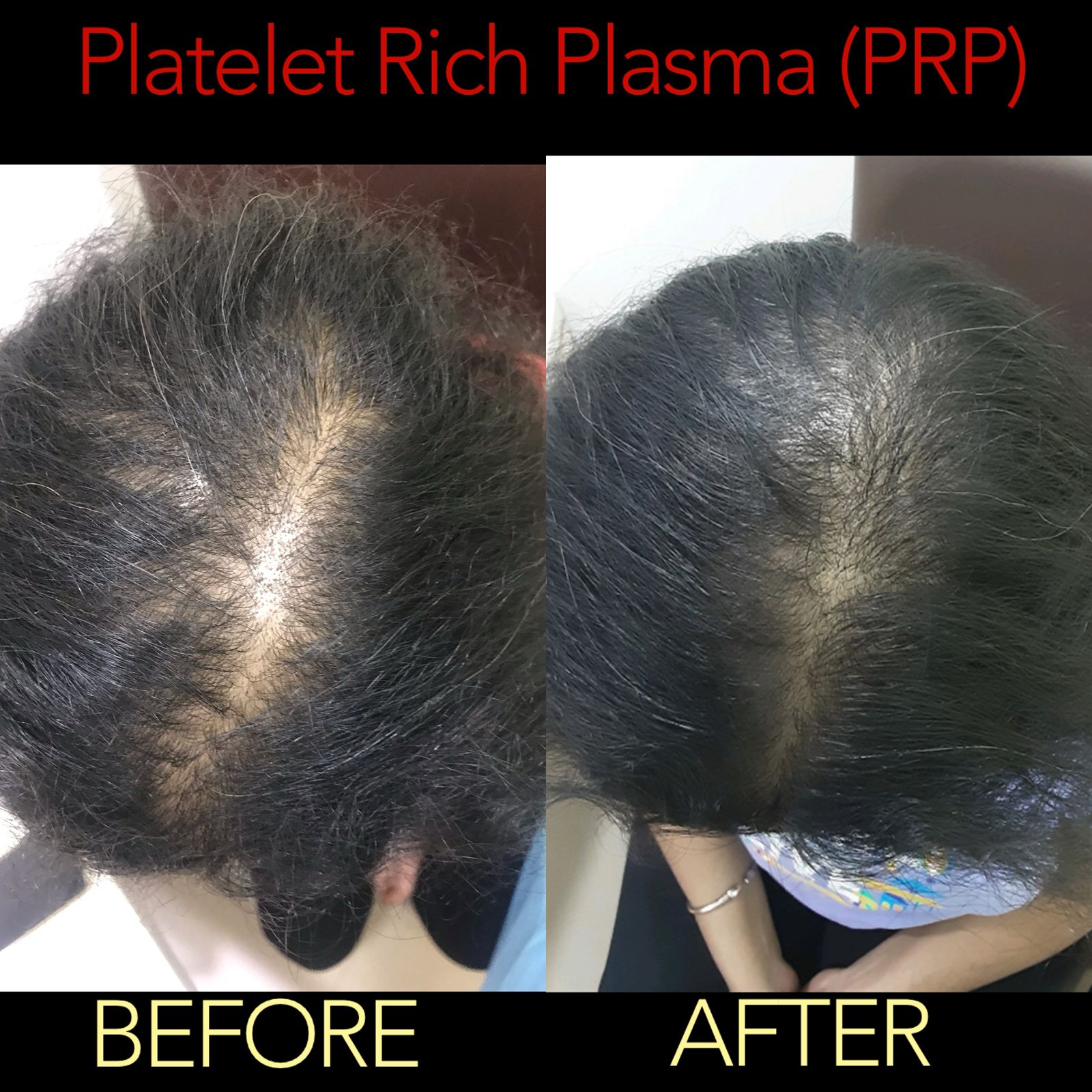 PRP