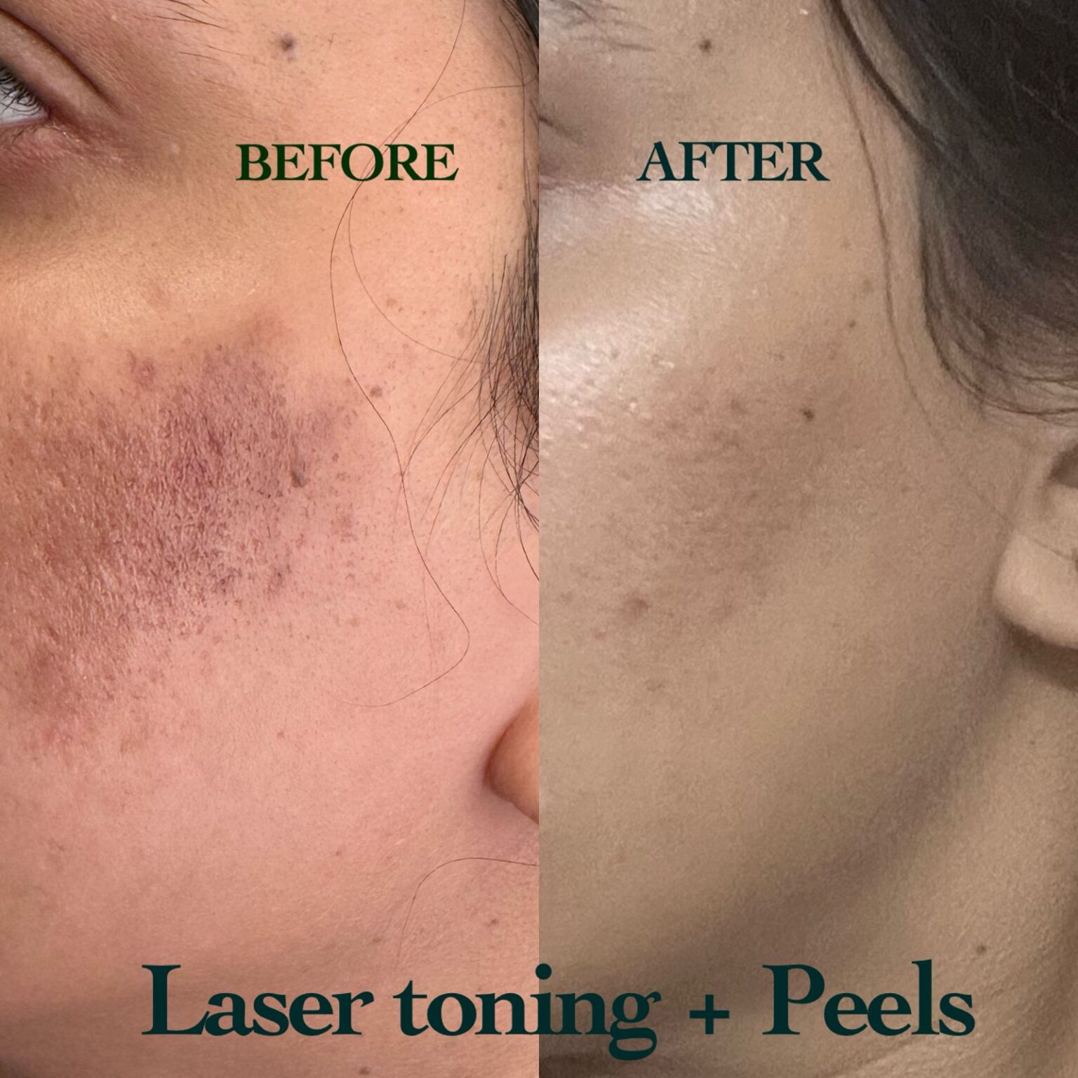 Chemical peels