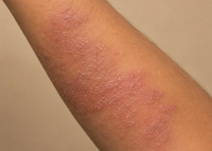 eczema img